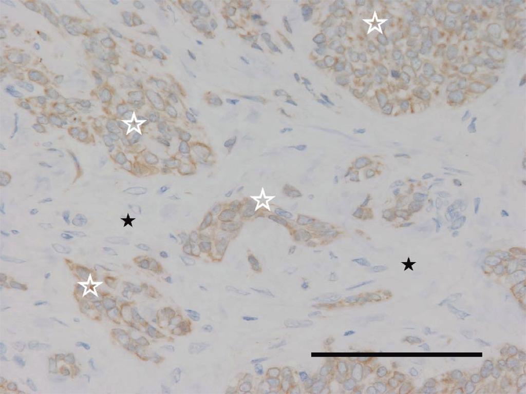 Immunohistochemical examination performed at this time demonstrated isolated keratin-positive epithelial cells within the stroma (Fig. 8).