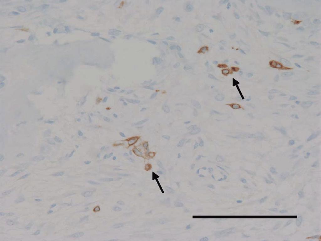 Classic damantinoma from Osteofibrous Dysplasia-like damantinoma 57 Fig. 8. Microphotograph demonstrating isolated keratin-positive epithelial cells (arrow) within the stroma. (Scale 100 μ).