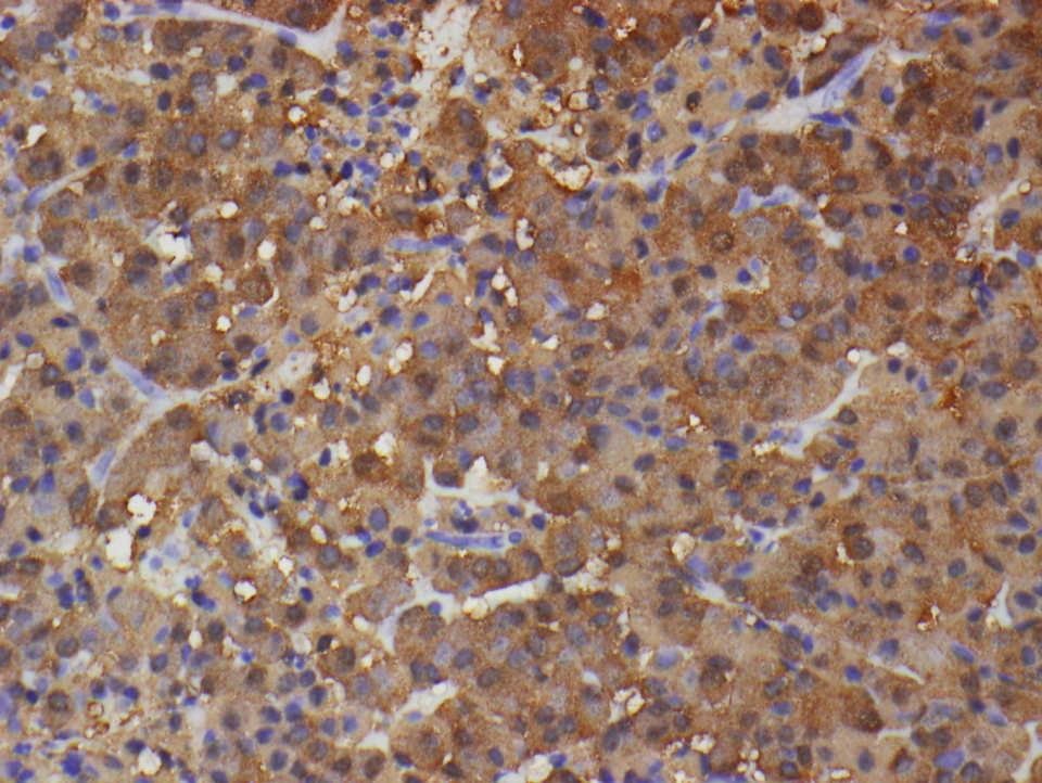 Otherwise similar to carcinoid tumors Immunohistochemistry: CHR, SYN, Pituitary Transcription Factors or Hormones FEATURE Lobular pattern Uniform nuclei Mitotic Figures Pituitary Adenoma Olfactory