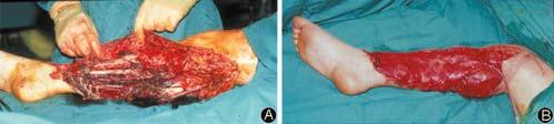 Initial assessment of major de-gloving 3C injury (A) treated by singe stage debridement, revascularisation, internal fixation and free flap cover (B) with a latissimus dorsi flap incorporating the