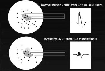 Myotonia Myotonia DDx Muscle fibre action potentials Classic waxing and waning in frequency +/- amplitude May present as waning-only discharges indistinguishable from a train