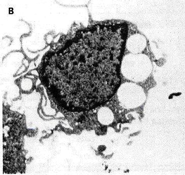 Slika 2: Elektronska mikroskopija - s parvovirusom B19 okuţene človeške matične eritroidne celice, in vitro. Prisotne so vakuole in citoplazemski psevdopodiji (1). 1.