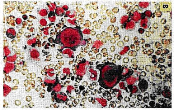 ne moremo določiti. Rdeče krvničke prenehajo zoreti, prisotni so veliki proeritroblasti (slika 4).