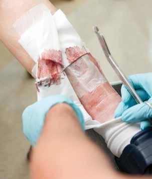 Enzymatic debridement may be used after surgical debridement. This helps clear your wound of unhealthy tissue and prepare it for healing.