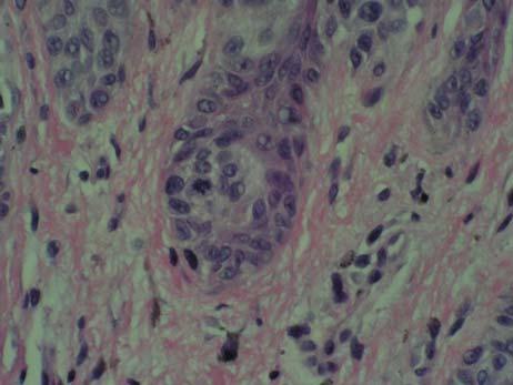 mitoses, pagetoid Congenital features, banal single filing Clefts,