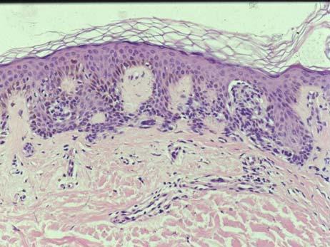 My 3 favorite things to distinguish melanoma from dysplastic nevus (but exceptions to all of this) 1. More pagetoid 2. More atypia 3.