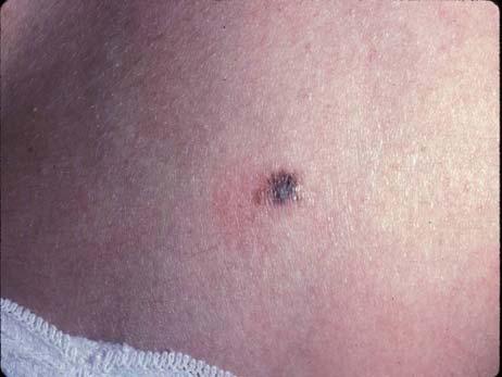 Recurrent nevus Do you think some recurrent nevi can