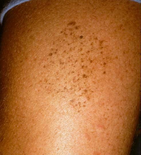 Nevus spilus = speckled lentiginous nevus Jean Bolognia thinks of nevus spilus (speckled lentiginous nevus) as a garden and within the garden you can have lots of things beside just background