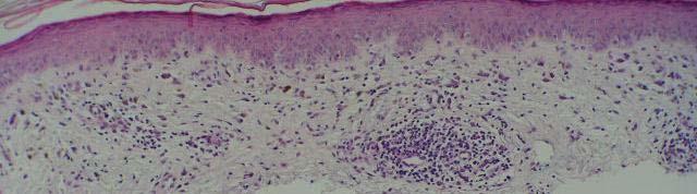 Pigmented lichenoid keratosis COMMON cause of consultation