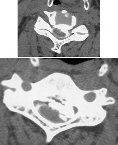 Radiculopathy of C-5 after anterior cervical decompression FIG. 5.