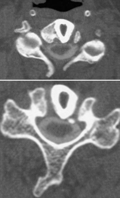 M. Ikenaga, et al. FIG. 7. Postoperative CT myelograms of the C3 4 (upper) and C4 5 (lower) levels revealing a successful decompression.