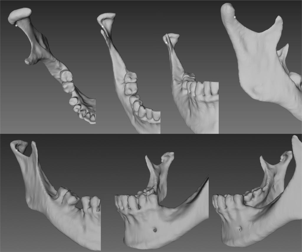 Material and methods The modification of the current classification of mandibular condylar fractures requires the introduction of two landmarks: 1.