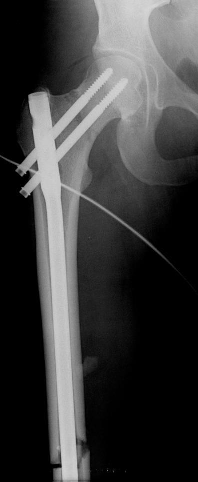 Femoral Neck Fractures in young adults Uncommon, 3-10% of all femoral neck fx Often result of high energy