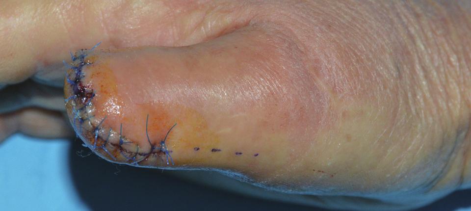 Frozen section reported that there was absence of melanoma in the lymph node and amputated product.