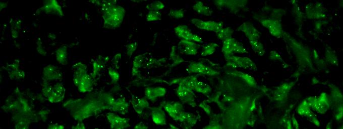 Molecular Assays for Staging Melanoma MSLT-1: Twice as many