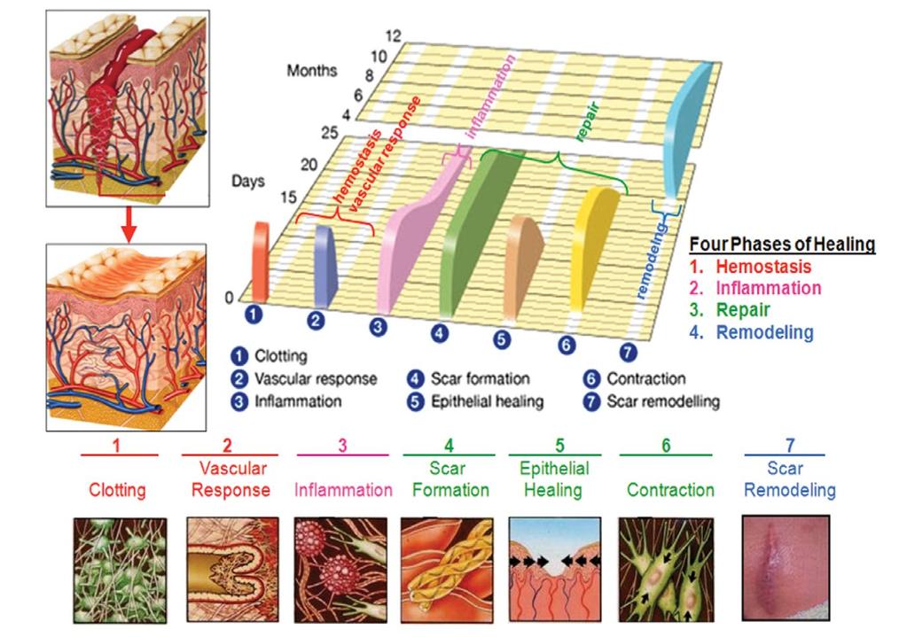 Plate 8. Sequence of wound healing. Normal skin wound healing proceeds through the 4 phases of hemostasis, inflammation, repair, and remodeling.