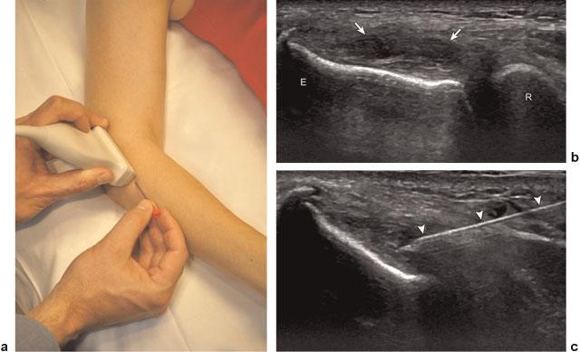86 Chiavaras, Jacobson Fig. 1 (a) Photograph shows needle and transducer position for a simulated common extensor tendon fenestration.