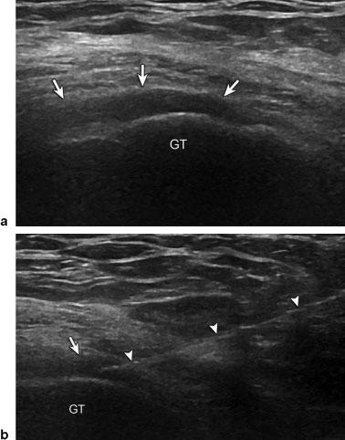 Chiavaras, Jacobson 87 Fig. 2 A 46-year-old man with tendinosis of the proximal semimembranosus and conjoint tendon and subsequent fenestration.