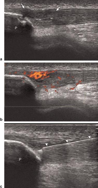 88 Chiavaras, Jacobson Fig. 4 A 22-year-old man with tendinosis of patellar tendon and subsequent fenestration.