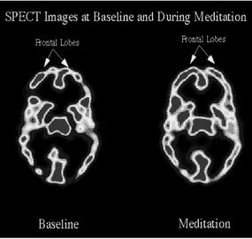 meditation and grey matter changes mindfulness and