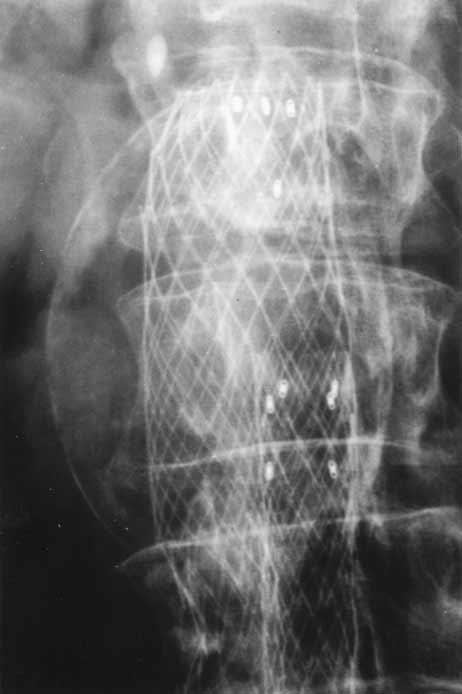 C, Abdominal radiograph at 25 months.