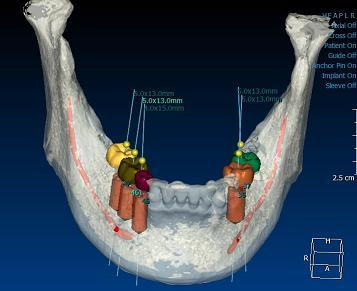 In general, it is in the shape of an orthodontic splint, and worn by the patient during surgery.