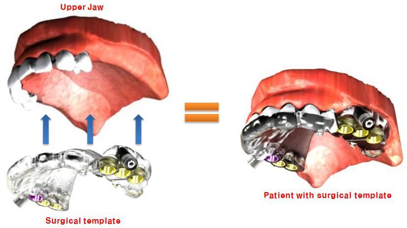 Surgical template placed in the patient s oral cavity - Endoscope navigation for brain surgery using virtual endoscope - Virtual