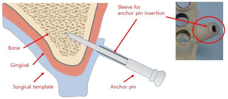 The drilling sequence is shown with an implant 4.0mm.