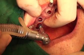 Implant installation Attach the guided surgery mount to the implant Place all implants Remove anchor