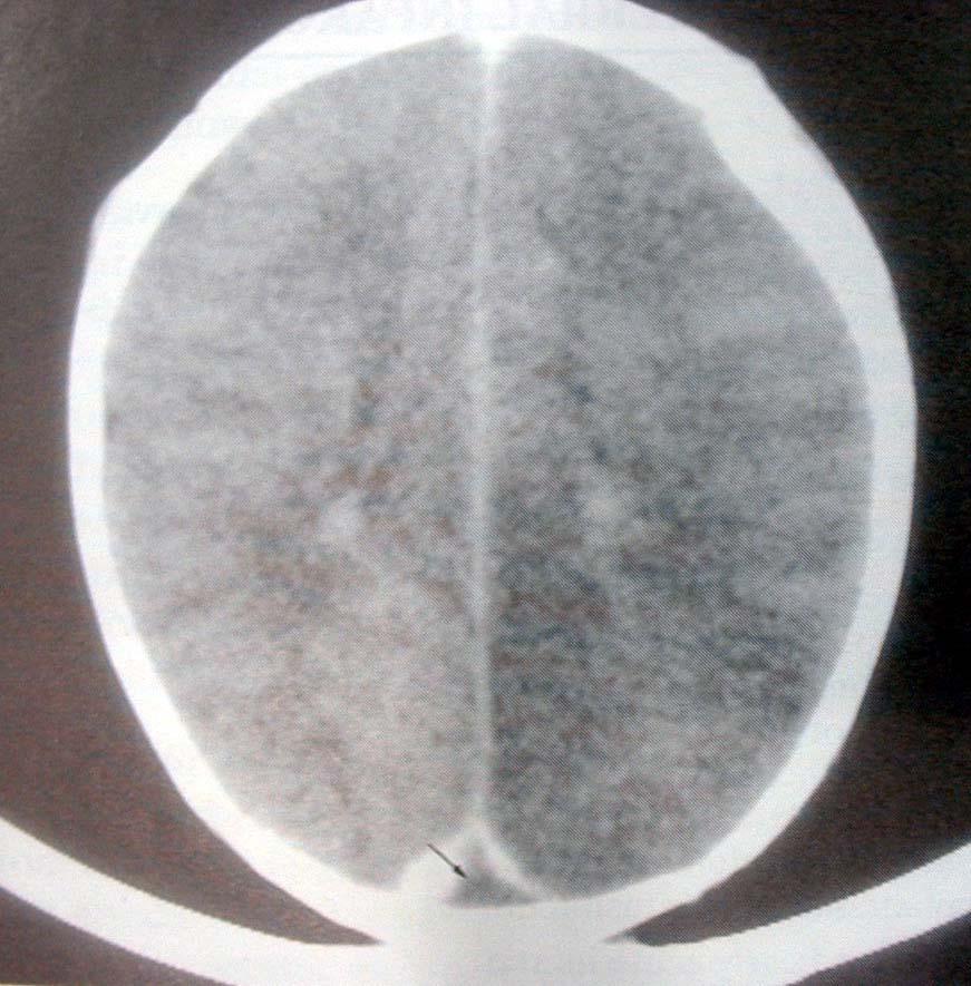 SSS thrombosis - CT case of female with headache conscious change and