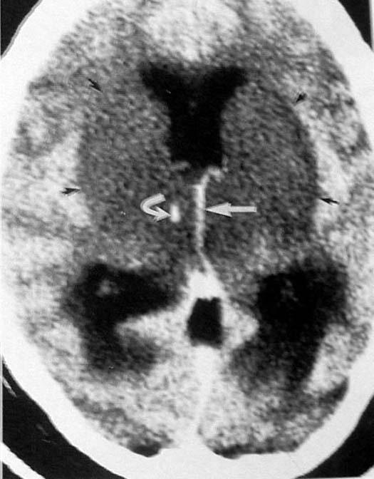 A case of coma thrombosis in deep venous system ( internal cerebral V)