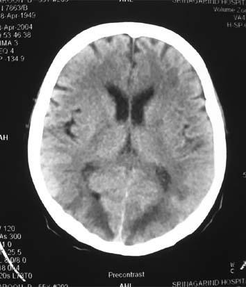A case of headache, hypertension and seizure Underlying HT,renal Low density in bilateral occipital lobe at cortex or subcortical
