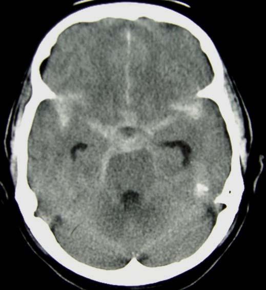 A case of severe sudden headache High density lesion in the cisterns Sylvian fissures