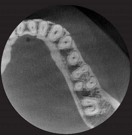 low. Endodontics - Smallest FOV(4X3cm) Optimized image size for endodontic