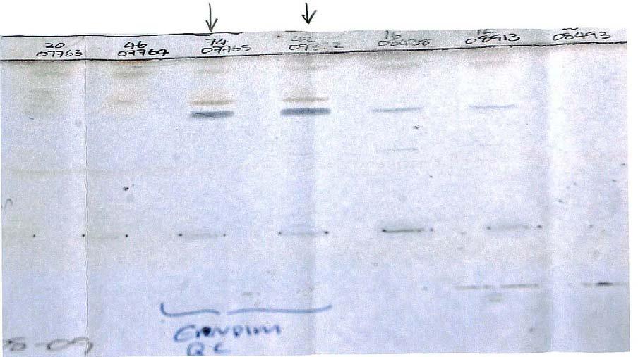 Sample F: Salla disease, Sialuria Patient: this was the common sample distributed in all 5 DPT schemes. This sample was obtained from a 6 year old female patient suffering from Salla disease.