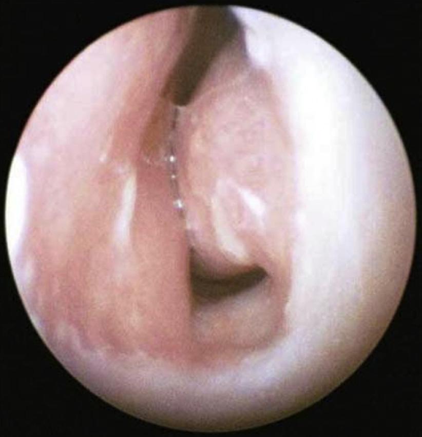 The quadrilateral cartilage is usually approached dorsally through a mucoperichondrial flap that is connected to a mucoperiosteal flap.