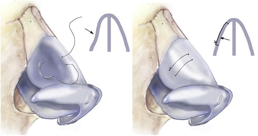 The quadrilateral cartilage is usually left attached to the anterolateral mucoperichondrium unless the caudal Fig. 3. A spreader graft being placed to correct internal nasal valve dysfunction.