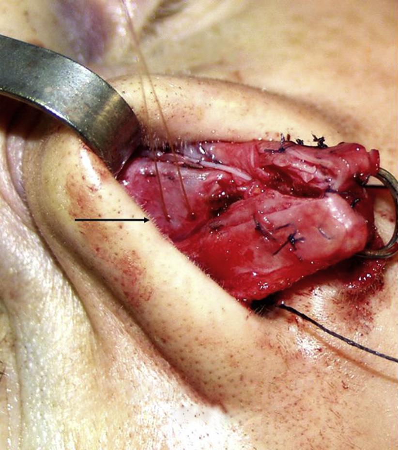 44 Teichgraeber et al Fig. 5. A mattress suture is placed to improve the internal nasal valve. straighten the deviated septum.