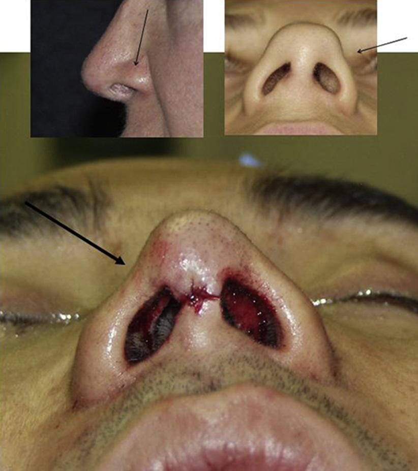 Surgical Management of Nasal Airway Obstruction 45 Fig. 7. Rim grafts can be considered when concavity of the rim exists. between the medial crura with a polydioxanone suture.