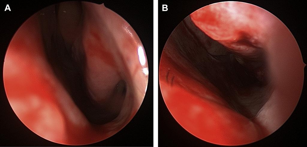 46 Teichgraeber et al Fig. 9. Intranasal view before (A) and after (B) septoplasty and turbinate reduction. described to treat the enlarged turbinates.