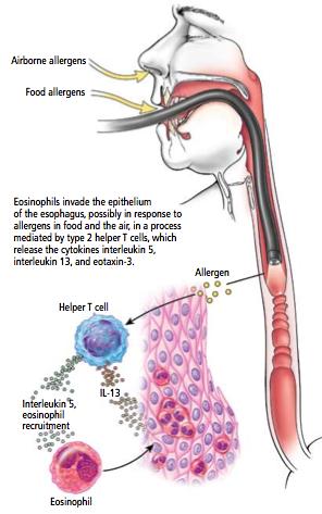Intraluminal allergen exposure Predominately food antigens Mucosal production of eosinophilic chemoattractants Influx
