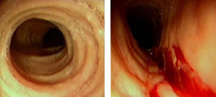 Hirano C. Foreign Bodies in the Esophagus. In: Shields, LoCicero, Feins, Reed, eds.