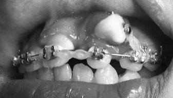 At month 3 (October 2007) treatment of tooth 21 that the rotation has been corrected, and the tooth 23 has moved to the distal in position collide with teeth 22 (Figure 5).