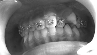 Wire is replaced with ss wire, ties eight ligation of teeth 21 and teeth in the left upper region and the withdrawal of the teeth 22 is carried out towards the mesial and pull the tooth 23 to