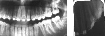 Utari : The treatment of anterior tooth crowded case of upper jaw with dental transposition 13 Figure 8. Figure 9.