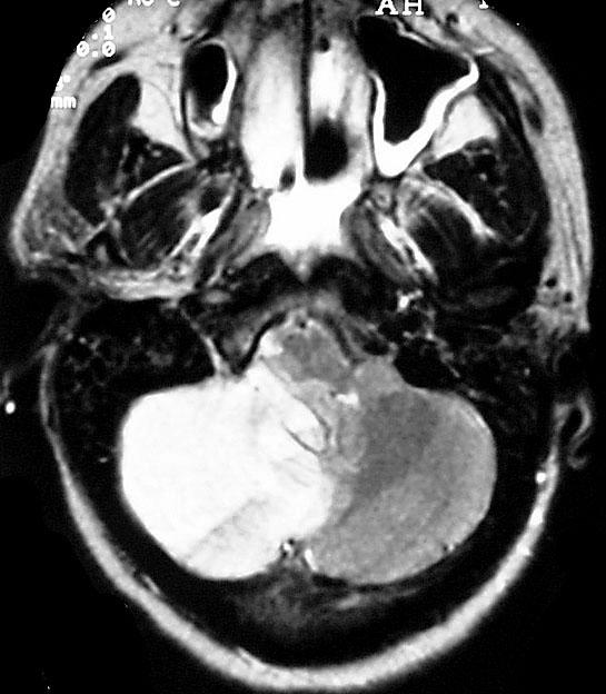 T2 MRI Infarct of