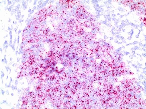 Since this antibody has recently been found to stain other tumors (besides breast and urothelial tumors), careful attention to staining and a panel approach is recommended.