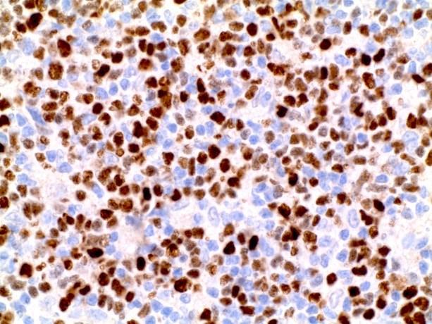 SOX11 (IHC) Most (90%) mantle cell lymphomas are SOX11 positive (even when t(11;14) translocation and cyclin D1 are not detected) and most mimics are SOX11 negative.