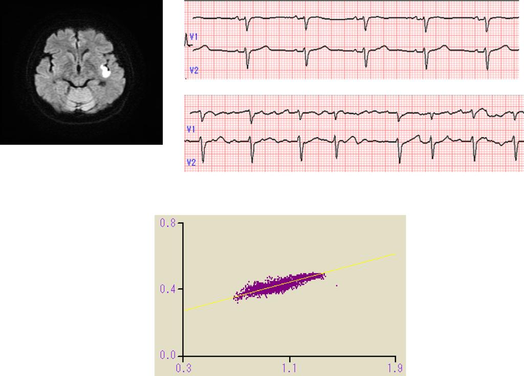 MRI DWI ECG QT-RR Regression Line QT Y=0.19X+0.25 R=0.89 RR=1.03 Figure 1. Representative QT-RR relationship in a 65-year-old woman with cardioembolic stroke.