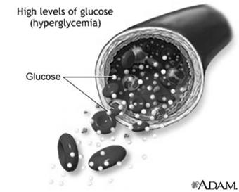 Polyphagia Ketosis Type II Diabetes Cause cellular resistance to insulin Usually seen in